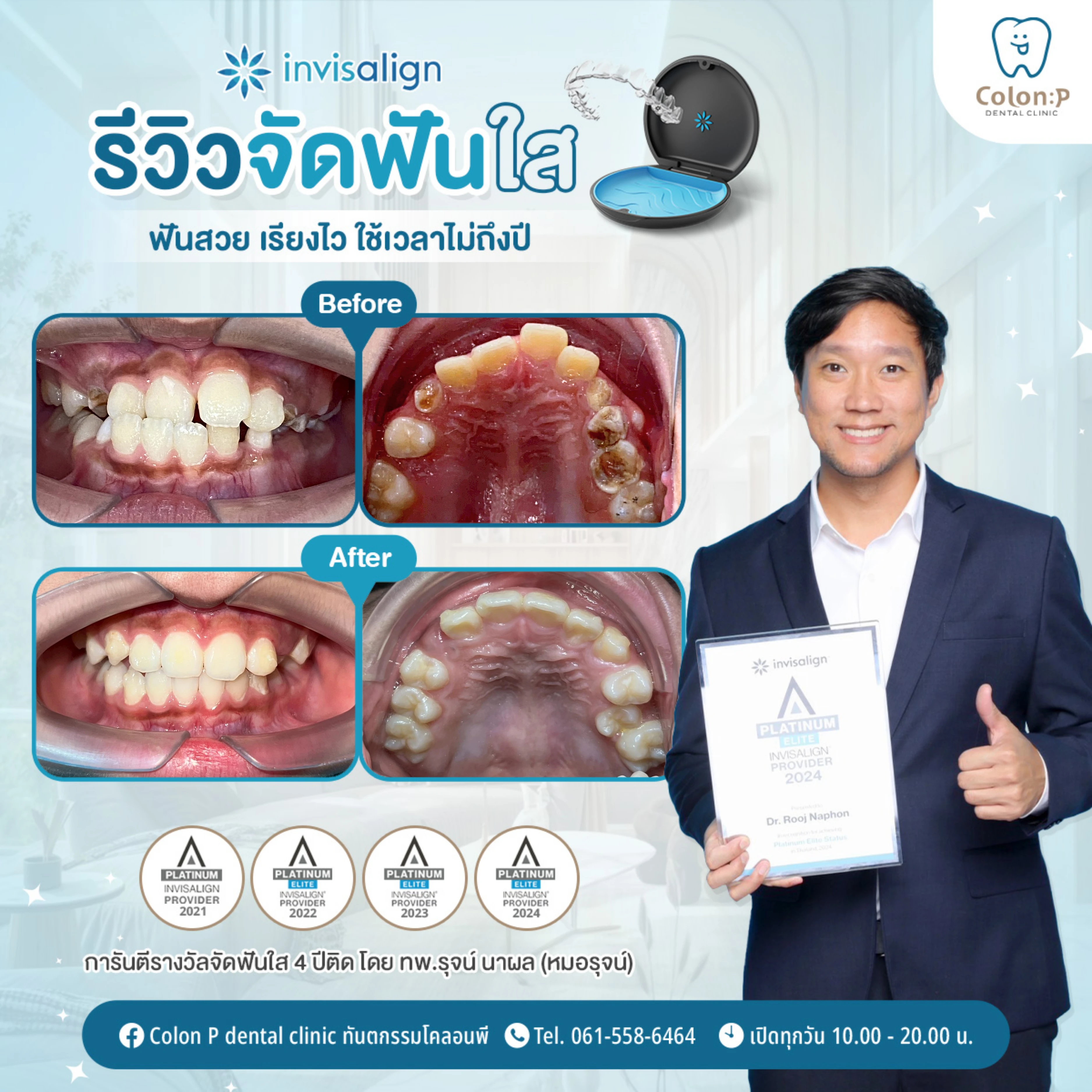 Colon P โคลอนพี คลินิกทำฟันโคราช ทันตกรรมครบวงจร จัดฟันใส invisalign ...