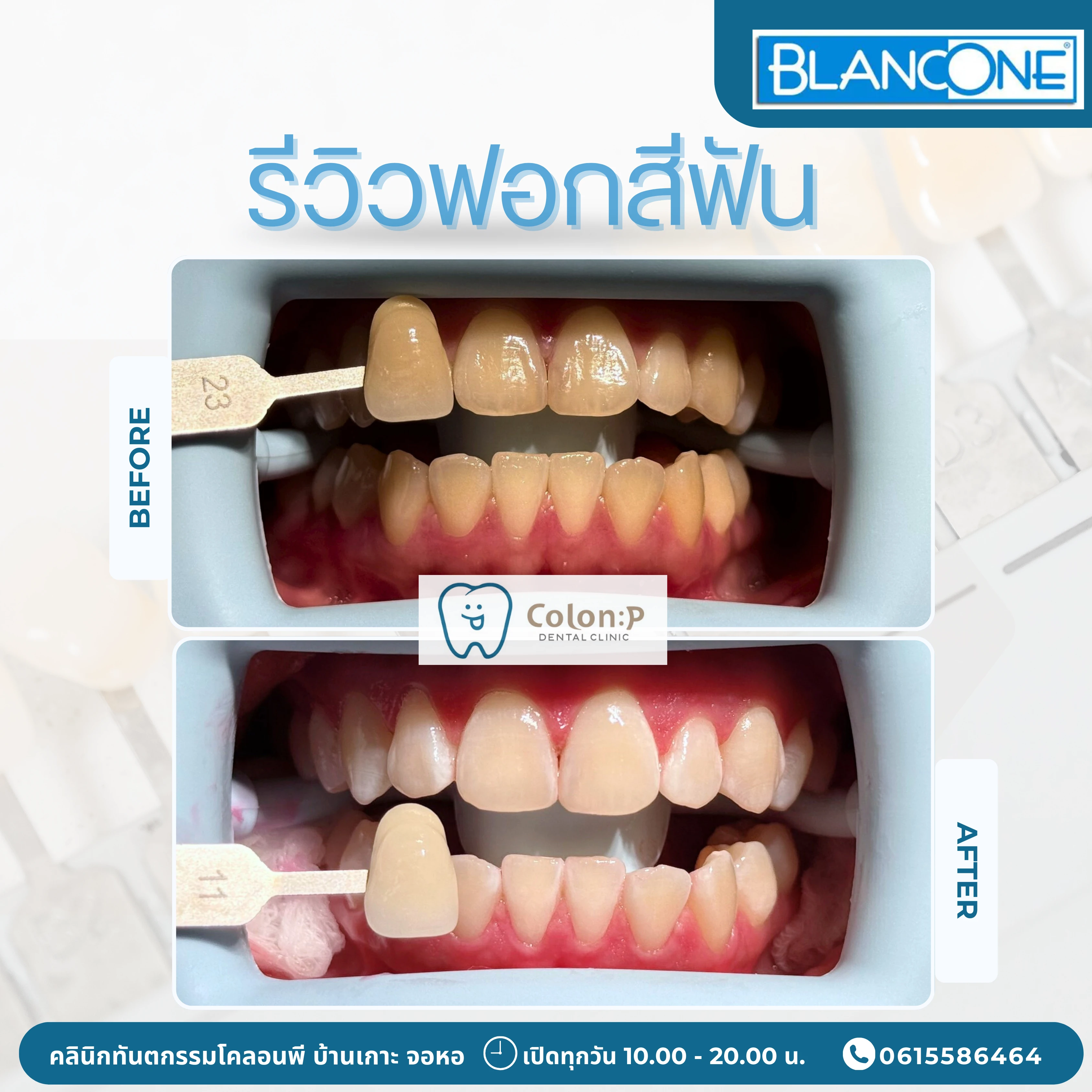 Colon P โคลอนพี คลินิกทำฟันโคราช ทันตกรรมครบวงจร จัดฟันใส invisalign ...