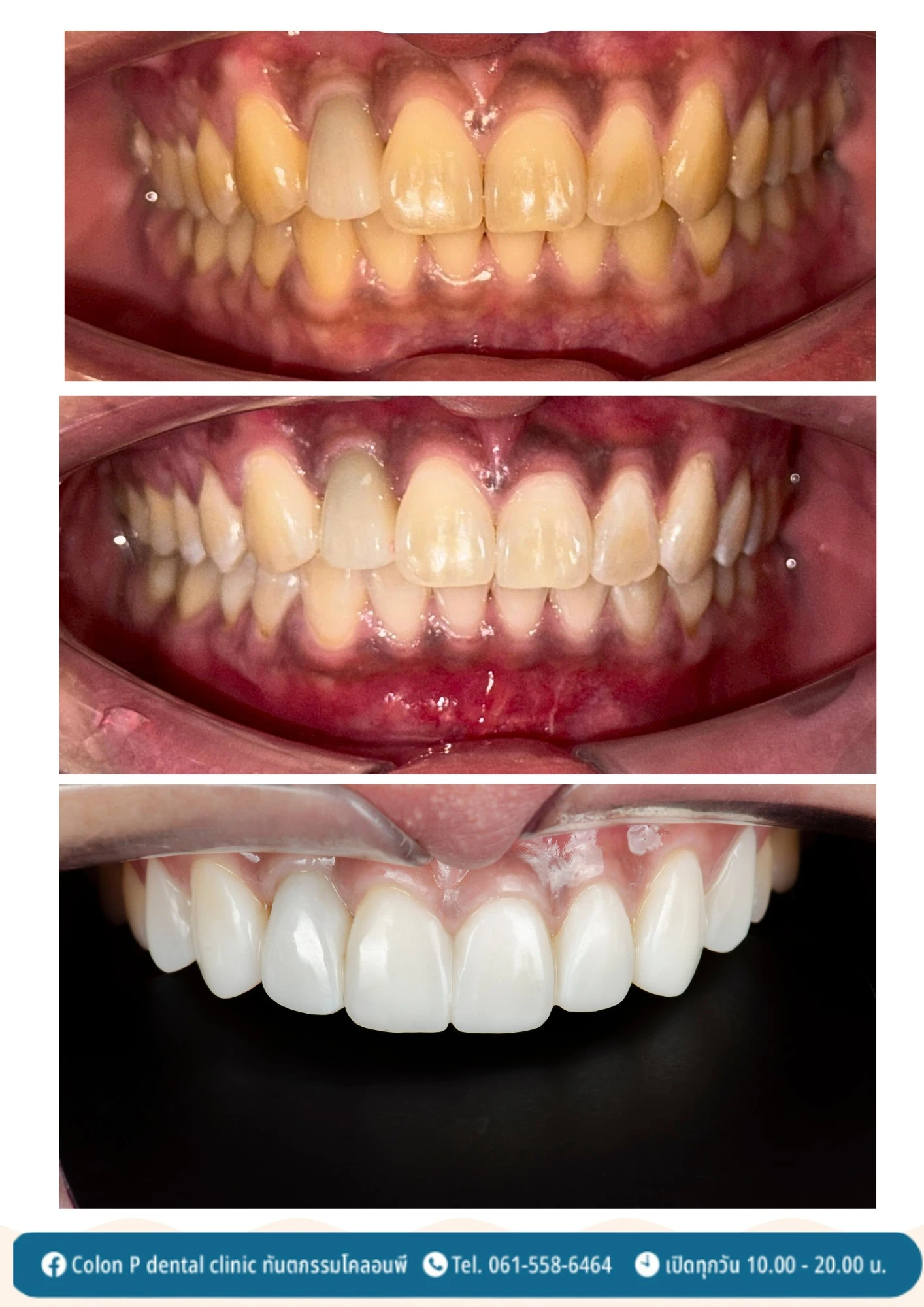 Colon P โคลอนพี คลินิกทำฟันโคราช ทันตกรรมครบวงจร จัดฟันใส invisalign ...